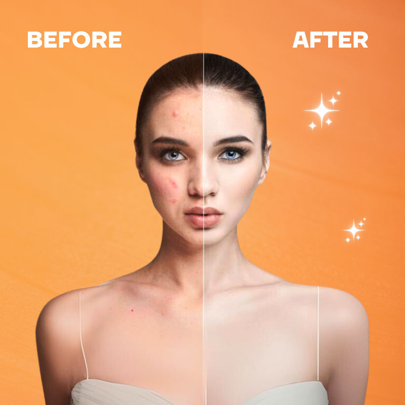 Sunscreen for Oily Skin, Anti Acne UV Face Gel SPF 50 PA++++ Glow, Matte & No White Cast