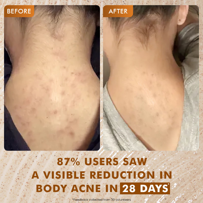 7% Exfoliating Body Wash- 1% Salicylic 2% Lactic Acid | Shower Gel to Reduce Body Acne