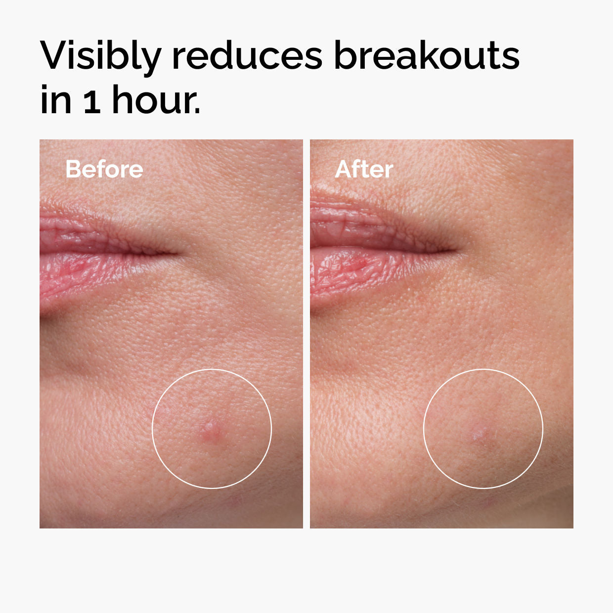 Sulfur 10% Powder-to-Cream Concentrate - Acne Spot Correction for Sensitive Skin